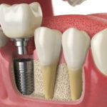 Dental Implant