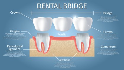 Dental Bridge